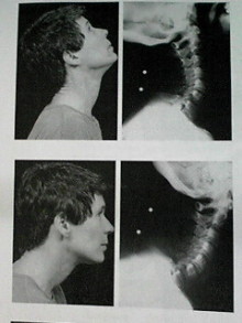 頸椎伸展画像